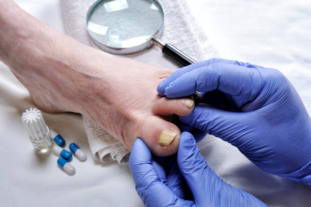 How Podiatrists Treat Fungal Nail Infections Effectively
